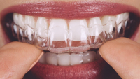 Niềng răng trong suốt bao lâu để hoàn thành quá trình ?