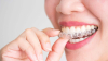 Phương pháp niềng răng trong suốt INVI&#039;S