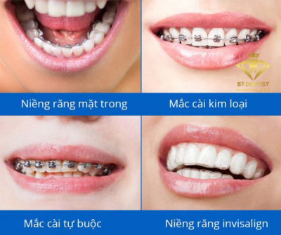 Niềng răng mắc cài sứ và những loại niềng phổ biến nhất hiện nay